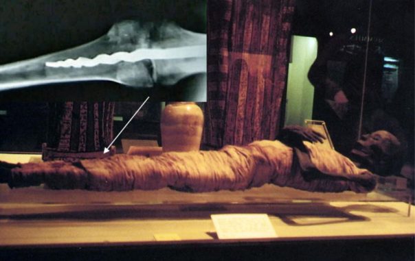 El Misterio Médico De Usermontu: ¿Por Qué El Descubrimiento De Un Tornillo En Una Rótula De 2600 Años Dejó Perplejos A Los Expertos? Usermontu-mummy
